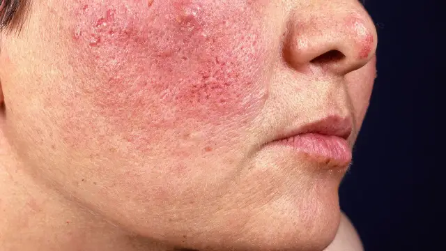 Rote Flecken im Gesicht: Endlich wissen, was wirklich hilft