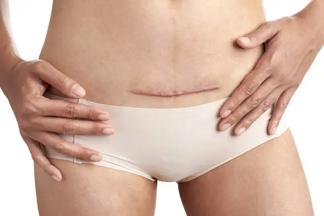 Jak długo trwa ból po cesarce? Co musisz wiedzieć o bólu po porodzie