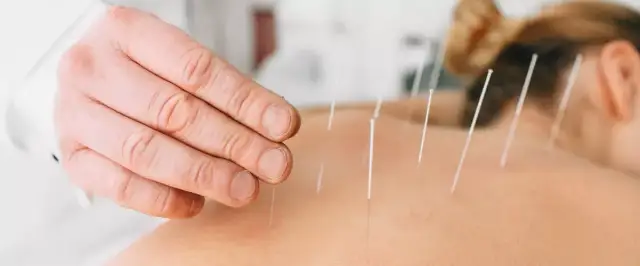 Akupunktura: Co to jest, jak działa i czy pomoże Ci?