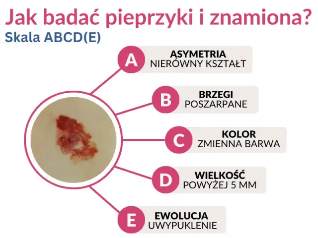 Wczesne objawy czerniaka: Jak rozpoznać i co robić?