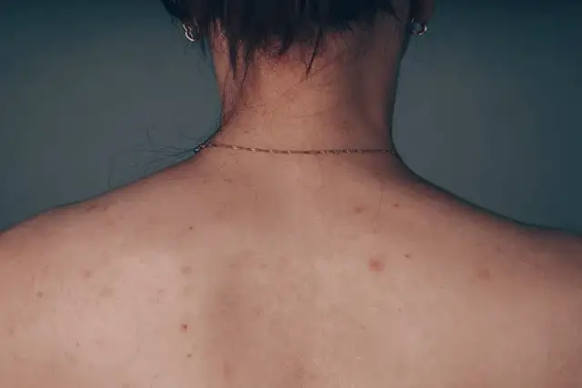 Jak szybko zagoić ranę po pryszczu? Skuteczne domowe sposoby