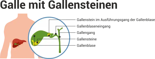 Verstopfte Gallengänge: Symptome erkennen & Ursachen verstehen
