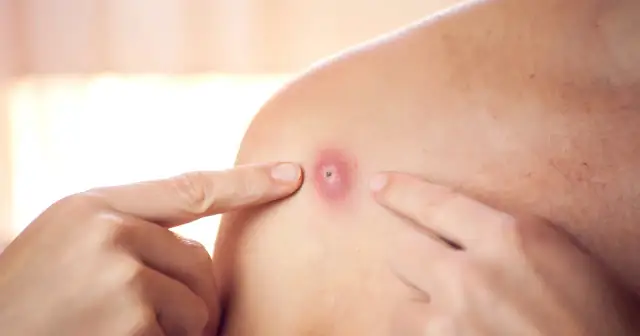 Co to jest pryszcz? Przyczyny, objawy i skuteczne metody leczenia