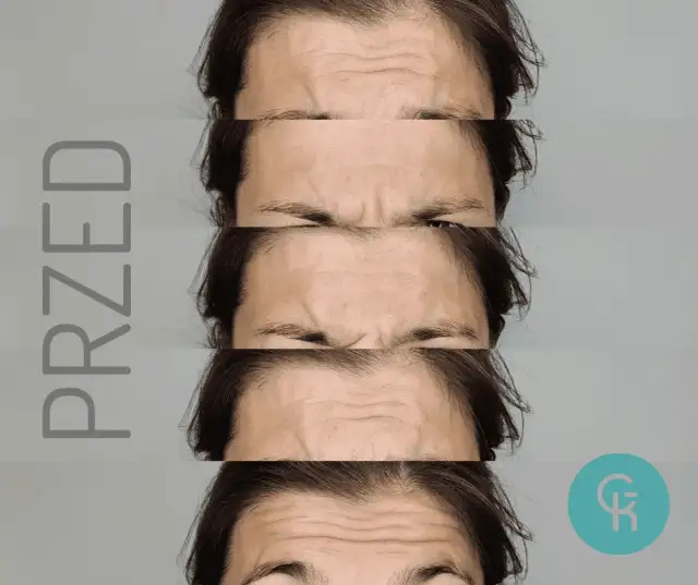 Kiedy botox zaczyna działać? Od pierwszych zmian do pełnego efektu.