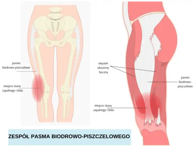 Jak długo trwa ból kolana po bieganiu i co go powoduje?