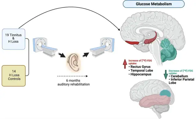 Szumy uszne: Czy piszczenie w głowie jest groźne? Jak sobie radzić?