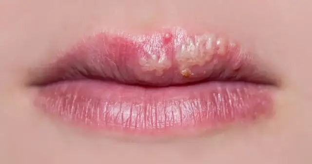 Widoczne pęcherzyki i zaczerwienienie na ustach, objawy opryszczki.