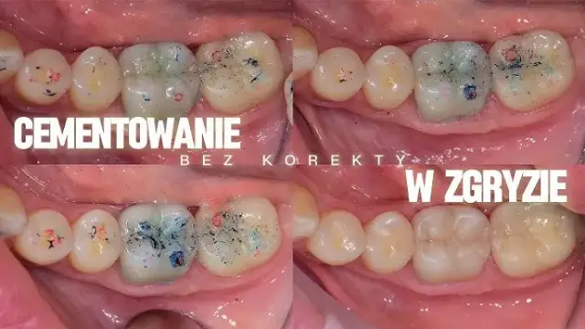 Jak stosować cement NoMIX, aby uniknąć nieprzyjemnych sytuacji z koronami dentystycznymi
