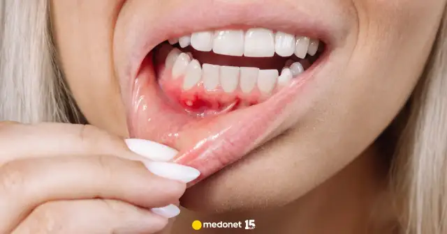 Ból dziąsła: Szybkie domowe sposoby, leki i kiedy iść do dentysty