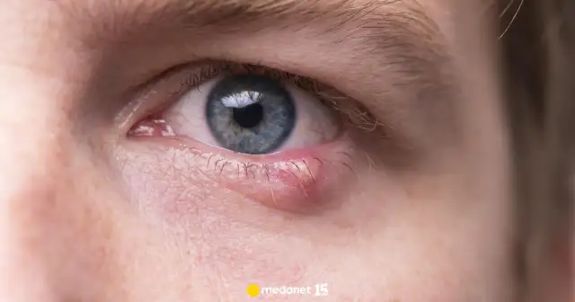 Jęczmień na oku: Leczenie bez recepty. Co naprawdę działa?