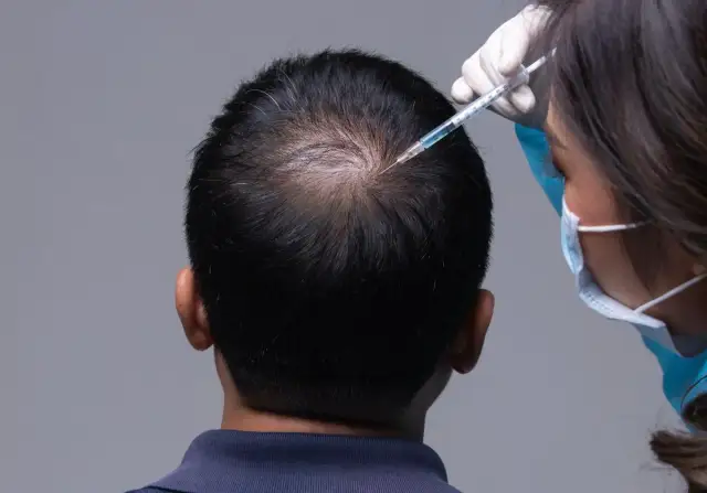 Łysienie telogenowe po chorobie: Odzyskaj włosy! Poradnik eksperta