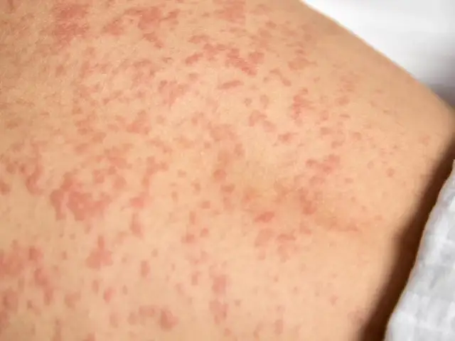 Uczulenie na antybiotyk - objawy, co robić, kiedy wezwać 112