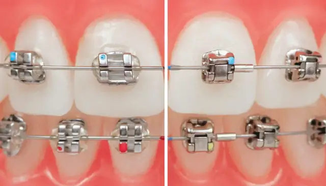 Stały aparat ortodontyczny: budowa, wygląd, rodzaje i zakładanie