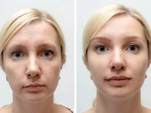 Przed i po: joga twarzy ćwiczenia wygładzają zmarszczki, odmładzając wygląd.