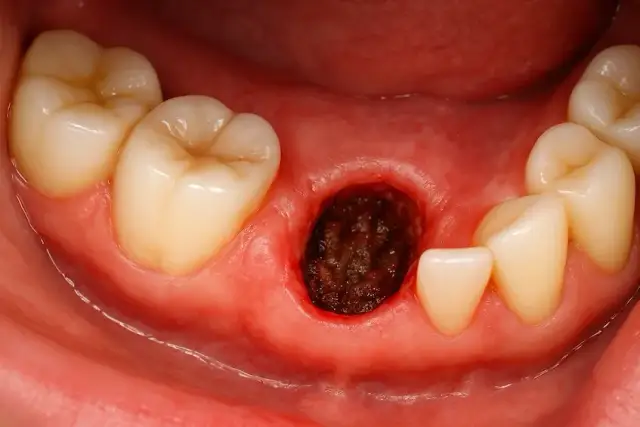 Jak uniknąć suchego zębodołu: skuteczne sposoby na uniknięcie bólu