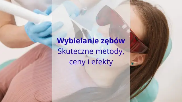 Profesjonalne wybielanie zębów: Metody, koszty, efekty czy warto?