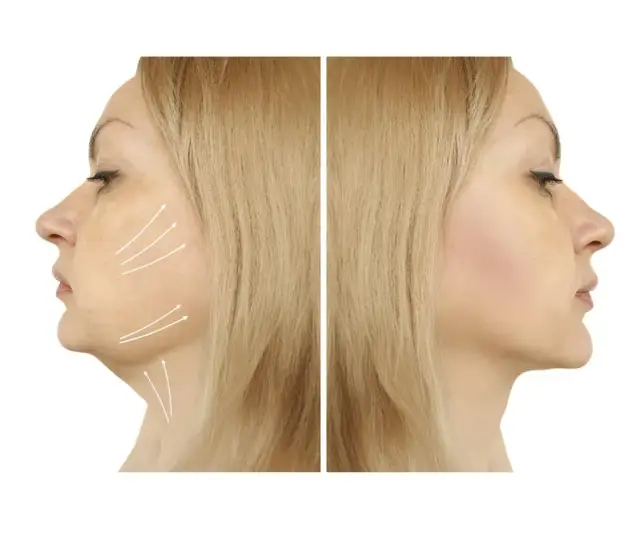 Ile kosztuje liposukcja podbródka? Ceny i ukryte wydatki, które musisz znać