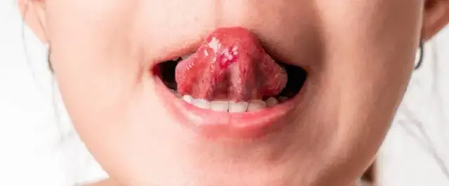 Pryszcz na języku co zrobić? Skuteczne sposoby na ulgę i leczenie