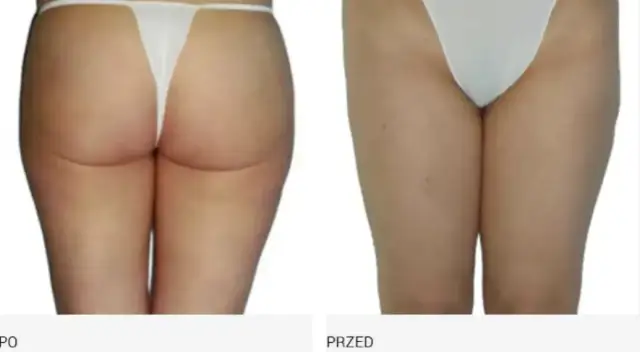 Jak często robić endermologię, aby uniknąć rozczarowania efektami?