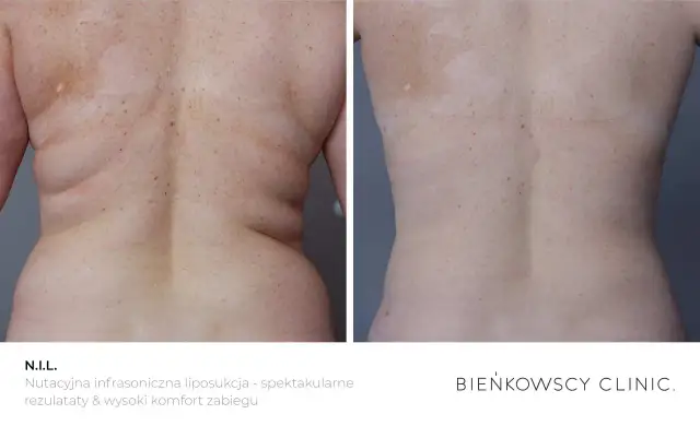 Liposukcja: Co to? Twój przewodnik po metodach, kosztach i ryzyku