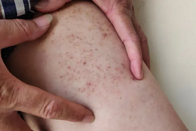 Jak się golić żeby nie było krostek – skuteczne sposoby na gładką skórę