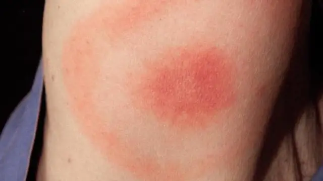 Qué pasa si te pica una garrapata: riesgos y cómo actuar rápidamente