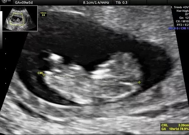 Pierwsze USG w ciąży: Kiedy wykonać, by czuć się spokojnie?