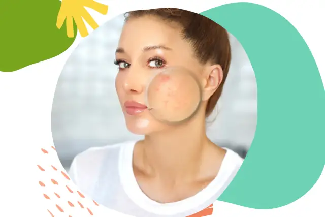 Jakie badania na trądzik u dorosłych mogą ujawnić przyczyny problemów?