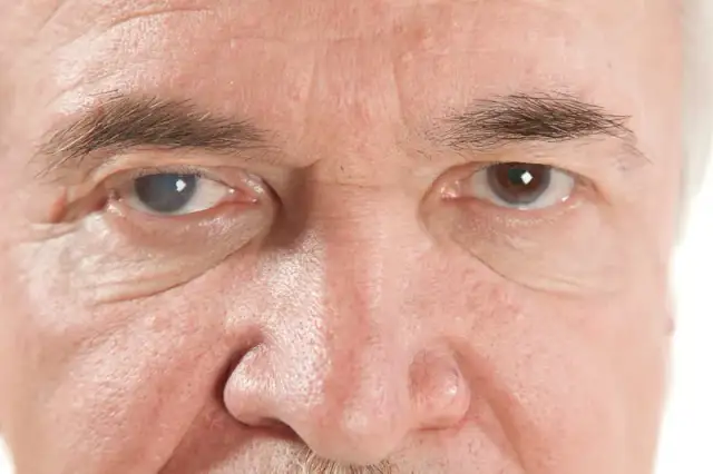 Objawy jaskry ocznej – jak je rozpoznać i uniknąć utraty wzroku