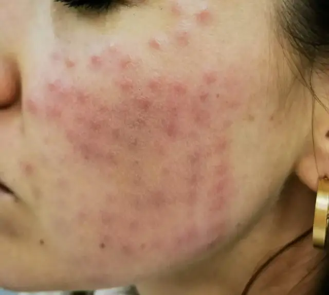 Skutki uboczne mezoterapii mikroigłowej: jakie ryzyka są realne?