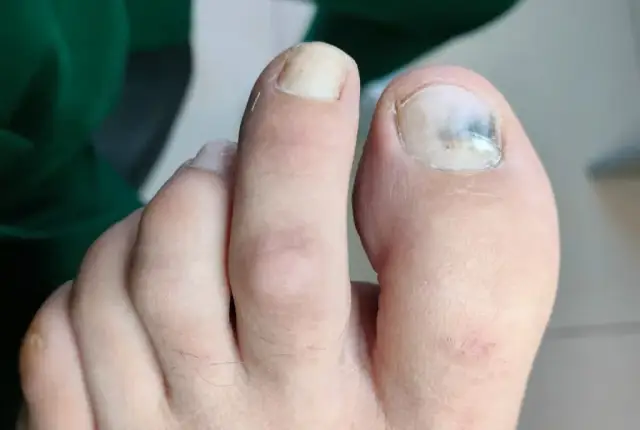 Jak wygląda schodzący paznokieć? Objawy i przyczyny, które musisz znać