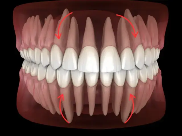 Zęby oczne: Które to kły i jak radzić sobie z ich bólem?