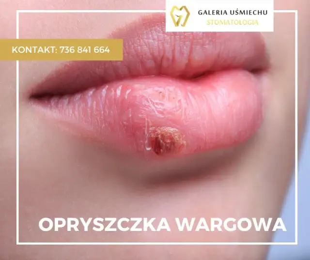 Wizyta u dentysty z opryszczką? Kiedy jest bezpieczna i co robić?