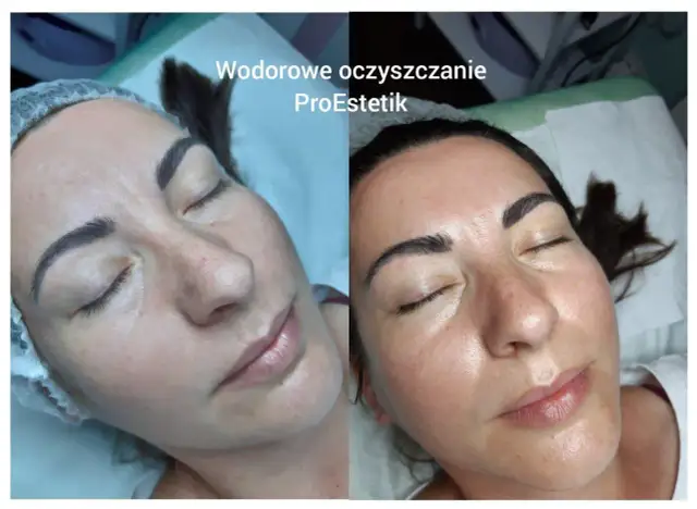 Oczyszczanie wodorowe twarzy - Czy warto? Poznaj realne efekty i ceny