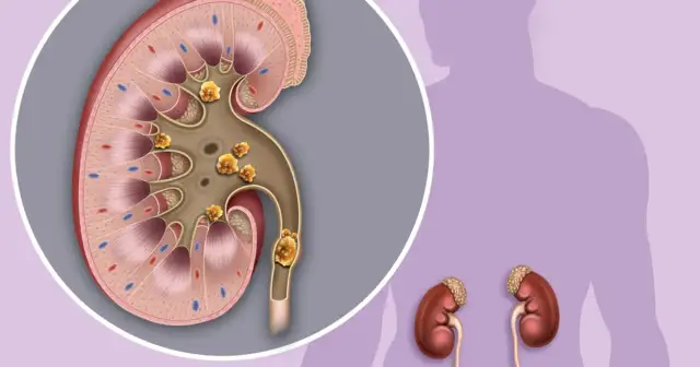 Jak długo trwa ból nerek po alkoholu? Objawy i co robić, by ulżyć