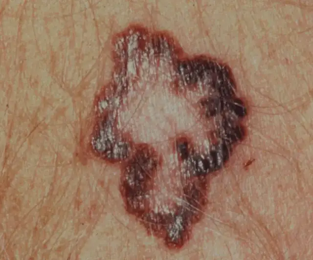 Co oznacza, gdy pieprzyk boli jak pryszcz? Sprawdź objawy i przyczyny