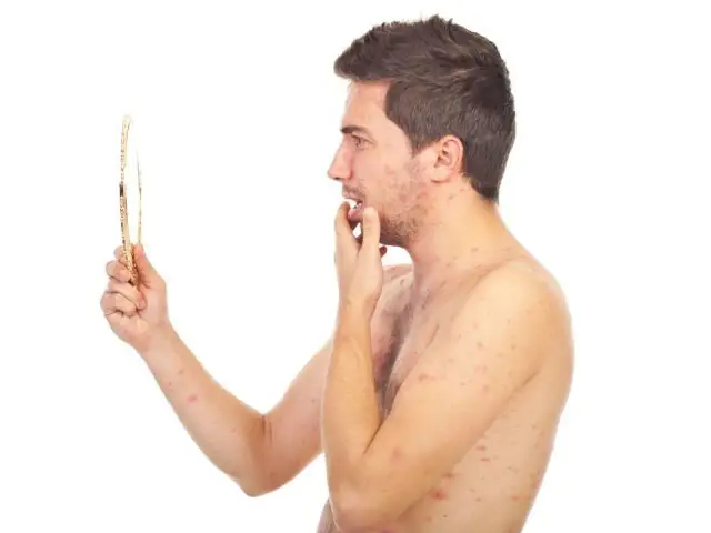 Jakie leki na ospę u dorosłych pomogą złagodzić objawy?