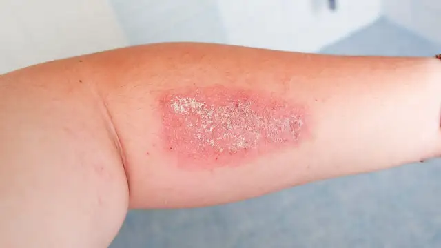 Gronkowiec MSSA - czy jest groźny? Objawy, leczenie, zapobieganie