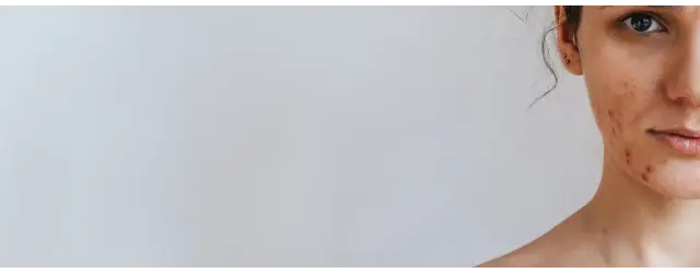 Jaki peeling do cery trądzikowej? Uniknij podrażnień i wybierz mądrze