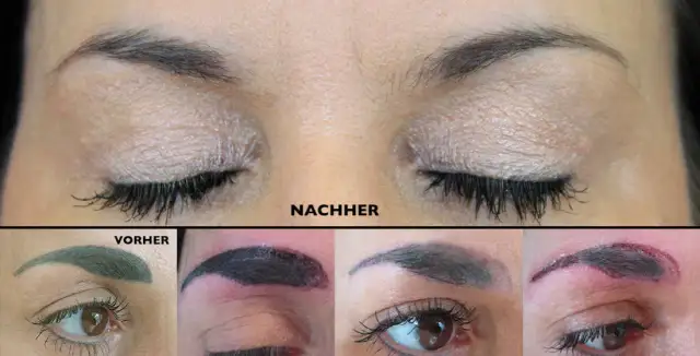 PMU entfernen: Was Sie über Laser, Remover & Kosten wissen müssen