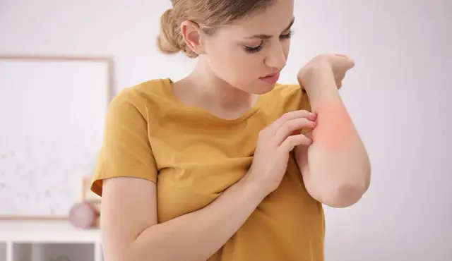 Alergia na roztocza: objawy skórne, AZS i jak sobie z nimi radzić