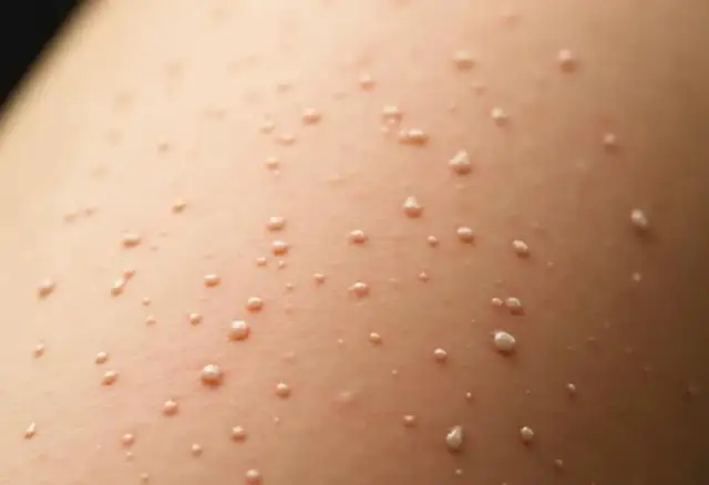 Grudki po kwasie hialuronowym: kiedy znikną i co robić?