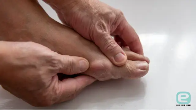 Atak dny moczanowej: Jakie leki OTC przyniosą natychmiastową ulgę?