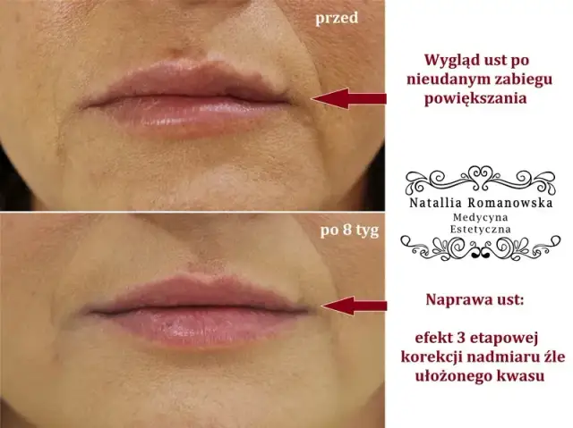 Kiedy można się całować po powiększaniu ust? Uniknij ryzyka infekcji