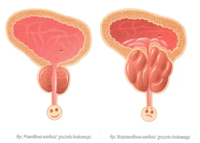 Wczesne objawy prostaty, które mogą zaskoczyć i zaniepokoić mężczyzn