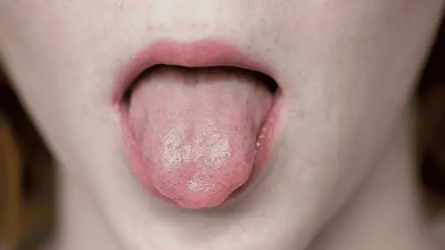 Usta z wyciągniętym językiem, na którym widać drobne nierówności, jakby mały bąbel pod językiem.