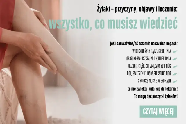 Jak zapobiec żylakom? Sprawdzone metody na zdrowe i lekkie nogi.