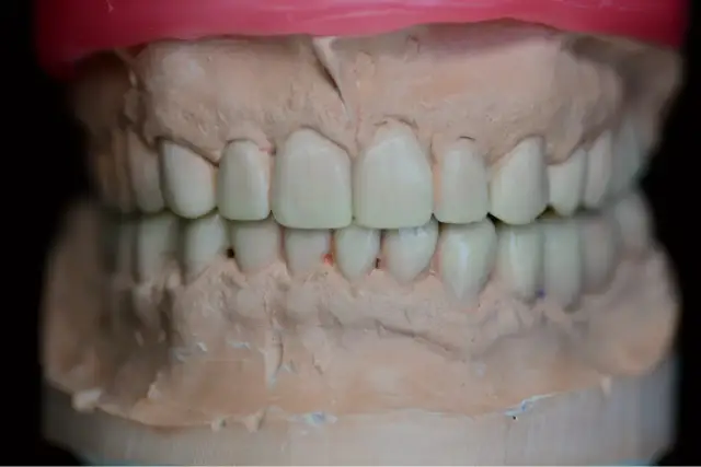 Model szczęki z protezą zębową. Dowiedz się, gdzie zrobić protezę zębową na NFZ.