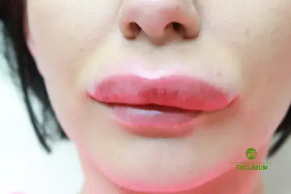 Zmniejsz opuchliznę po kwasie hialuronowym: porady ekspertki