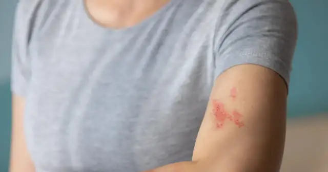 Jakie leki na półpasiec skutecznie łagodzą ból i przyspieszają leczenie